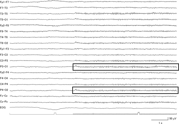 Clear evidence for a diffuse photic driving response (within boxes) in a patient with corticobasal degeneration with low voltage background activity.