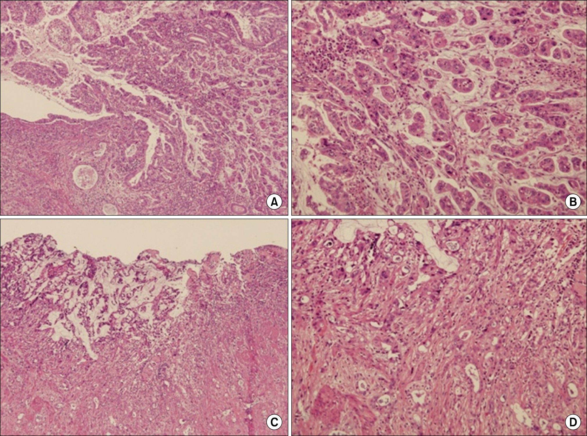 Hematoxylin & Eosin stain image of tumor. Tumor shows polypoid growth into the common bile duct (CBD) lumen with pancreatic invasion. (H&E; A, ×40; B, ×100). Adenocarcinoma of the gallbladder invaded fibromuscular connective tissue (H&E; C, ×40; D, ×100).