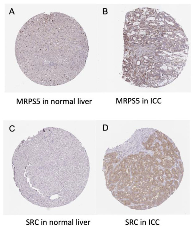 Immunohistochemistry of the MRPS5 and SRC genes in ICC and normal liver tissues. (A) MRPS5 in normal liver (cholangiocyte staining: not detected; intensity: negative; quantity: none). (B) MRPS5 in ICC (staining: low; intensity: weak; quantity: 75–25%; location: cytoplasmic and membranous). (C) SRC in normal liver (cholangiocyte staining: not detected; intensity: negative; quantity: none). (D) SRC in ICC (staining: medium; intensity: moderate; quantity > 75%; location: cytoplasmic and membranous).