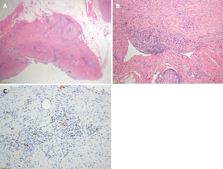 Histopathological examinations. A: The thickened bile duct wall demonstrates a marked sclerosis with diffuse lymphoplasmacytes and some eosinophils infiltration; B: Obliterative phlebitis is apparent; C: Numerous IgG4+ cells are detected by immunohistochemical staining.