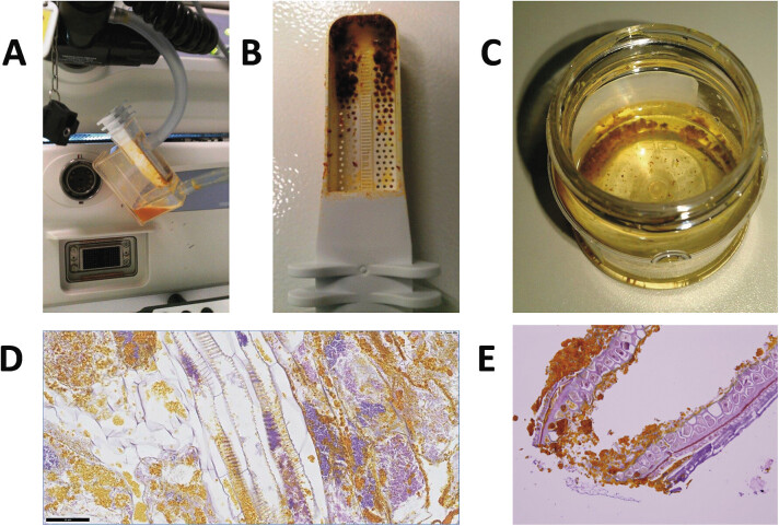 Sampling and microscopic examination of biliary material using a polyp-trap device. ( A ) Polyp-trap device with bile-colored duodenal aspirate. ( B , C ) Strainer tray and specimen container with crumbly material. ( D ) Microscopy showing large vegetable fiber. ( E ) Vegetable fibers with debris and bacteria.