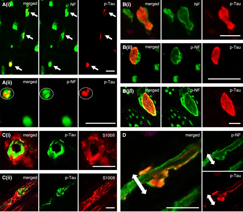Double-labelled immunofluorescence of phosphorylated-tau (p-tau) and neurofilament/S100β: the morphological features and localization sites of p-tau deposits in the peripheral nerve fibres. (A) In cross sections, phosphorylated tau deposits are primarily localized within the neuronal fibres (i)/axons (ii). (B) Some of the nerve fibres are filled with large tau inclusions showing fibrillary morphology (i–iii). (C) A part of the large tau-positive inclusions appear to accumulate in the lateral portion of nerve fibres, suggesting the possibility that the deposits are partly located within myelin. However, p-tau and S100β are not completely co-localized, and p-tau deposits merely appear to overlap on the myelin [C(i): cross and C(ii): sagittal section]. (D) Sagittal section of D-IF: p-tau and p-NF. In support of this, p-tau deposits with the outer portion are present within the axons (p-NF). In addition, the axons detected with p-NF seem to be bulged due to the large tau-positive inclusions. [A(i) and B(i)] NF (green) and pThr217 (red), [A(ii), B(ii and iii) and D] SMI31 (green) and pThr217 (red) and (C) AT8 (green) and S100β (red). Scale bars in A–D = 10 μm.