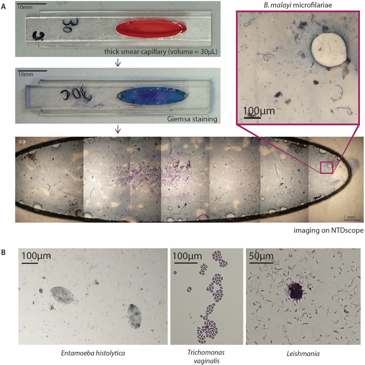 The NTDscope can image parasites on fixed and stained slidesA (top left) picture of a thick smear capillary designed to be imaged with the NTDscope, including 30µL of blood from a cat infected with Brugia malayi. (middle left) Thick smear capillary after Giemsa staining. (bottom) stitched images of Giemsa-stained capillary, collected with the NTDscope, with an inset showing 6 B. malayi microfilariae (top right). The full video shown in Supplementary Video 3. B Images of fixed and stained slides with parasites, collected on the NTDscope, showing (left) Entamoeba histolytica, (middle) Trichomonas vaginalis, and (right) Leishmania donovani promastigotes.