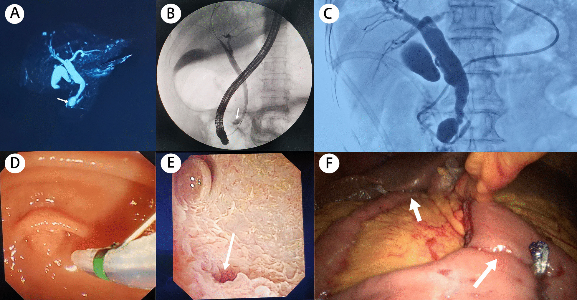 Preoperative and intraoperative findings. A MRCP showed cystic dilatation of the distal common bile duct (arrow). B ERCP showed cystic dilatation of the distal common bile duct (arrow). C ERCP showed an anomalous pancreaticobiliary duct junction. D Duodenoscopy showed that the duodenal papilla was flat and granular with no protrusions. E Choledochoscopy showed the opening of the cyst (arrow). F Laparoscopic hepaticojejunostomy was used to treat the type III cysts