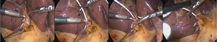 The Figures 1–4 show the process of the insertion of C-duct through the cystic duct. It is necessary to adjust the direction of the cystic duct and maintain proper tension. The first depth of the insertion is about 10.0 cm and is gradually adjusted to 5.0 cm to avoid passing through the Oddi's sphincter. The Duncan knot can ensure the rapid closure of the cystic duct and avoid bile leakage.