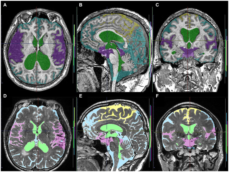 Input image masks as the ground truth labels transferred to the cloud-based AI development service. The upper axial (A), sagittal (B), and coronal (C) images on 3D T1-weighted MRI in the same Hakim patient as the upper panel of Figure 1 show the input image masks including total ventricles (green), Sylvian fissure and basal cistern (purple), high-convexity part of the subarachnoid space (yellow), and the other subarachnoid spaces (marine blue). The lower axial (D), sagittal (E), and coronal (F) images on 3D T2-weighted MRI in the same healthy volunteer as the lower panel of Figure 1 show the input image masks for deep learning including total ventricles (light green), Sylvian fissure and basal cistern (pink), high-convexity part of the subarachnoid space (yellow), and the other subarachnoid spaces (light blue).