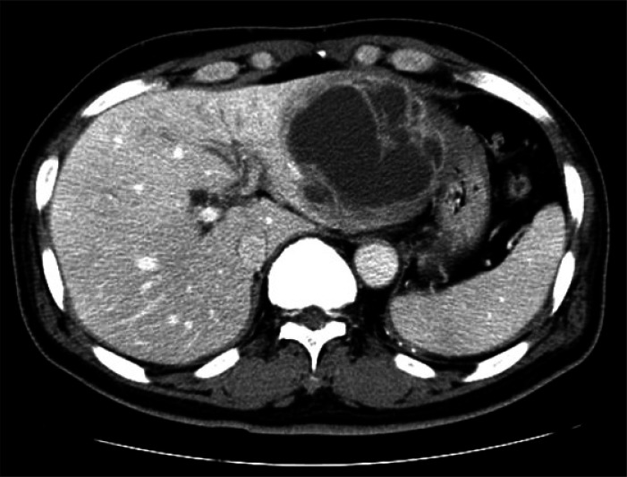 Initial abdomen computed tomography shows about 9 cm lobulating low attenuating mass with peripheral rim enhancement with enhancing septum like structures in the left lobe of the liver.