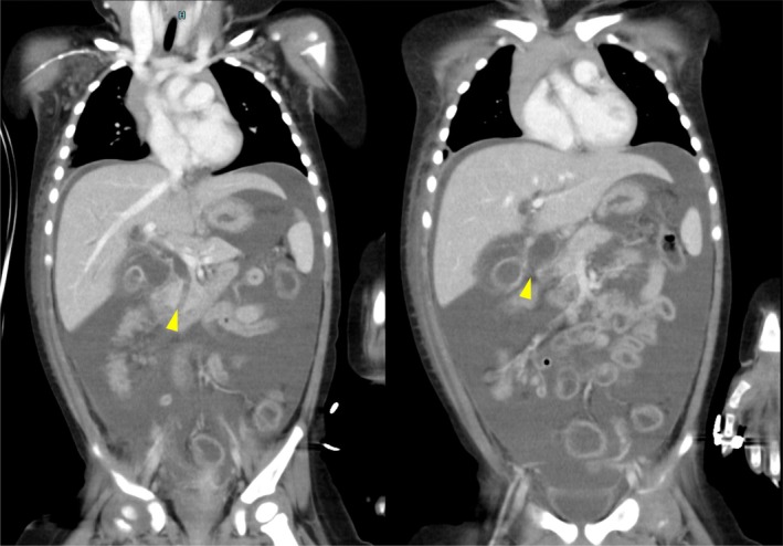 Preoperative contrast‐enhanced computed tomography. Contrast‐enhanced computed tomography (CT) revealed massive ascites, marked dilation of both intrahepatic and extrahepatic bile ducts, and a 19 mm‐long common channel containing a hyperdense structure suggestive of a protein plug (the left arrowhead). A discontinuity in the anterior wall of the common bile duct is indicative of perforation (the right arrowhead).