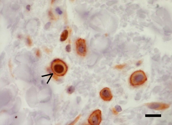 Double immunohistochemistry with CD117 and Ki67. Mast cells are CD117 positive membrane stained cells; One of them (arrowhead) shows also nuclear immunoreactivity (Ki67) indicating its proliferating status. Streptavidin-peroxidase method. Scale bar = 20 μm.