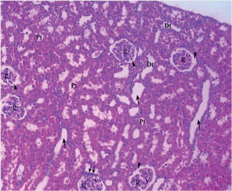 Renal tissue in diabetic ischemia reperfusion treated with dexmedetomidine group (Group DM-I/R-D). Pt: Proximal tubule, Dt: Distal tubule, g: glomerulus, v: vacuole, arrow head: bowman space, arrow: dilated tubule, double arrow: macula densa (H&EX10).