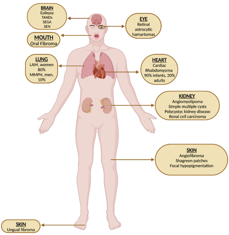 Clinical manifestations of TSC.