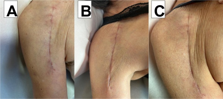 Clinical appearance of the scar following reverse shoulder replacement: (A) before treatment (baseline); (B) on Day 7 of treatment; and (C) on Day 21 of treatment (last day). The surgeon evaluates the scar's recovery clinically.