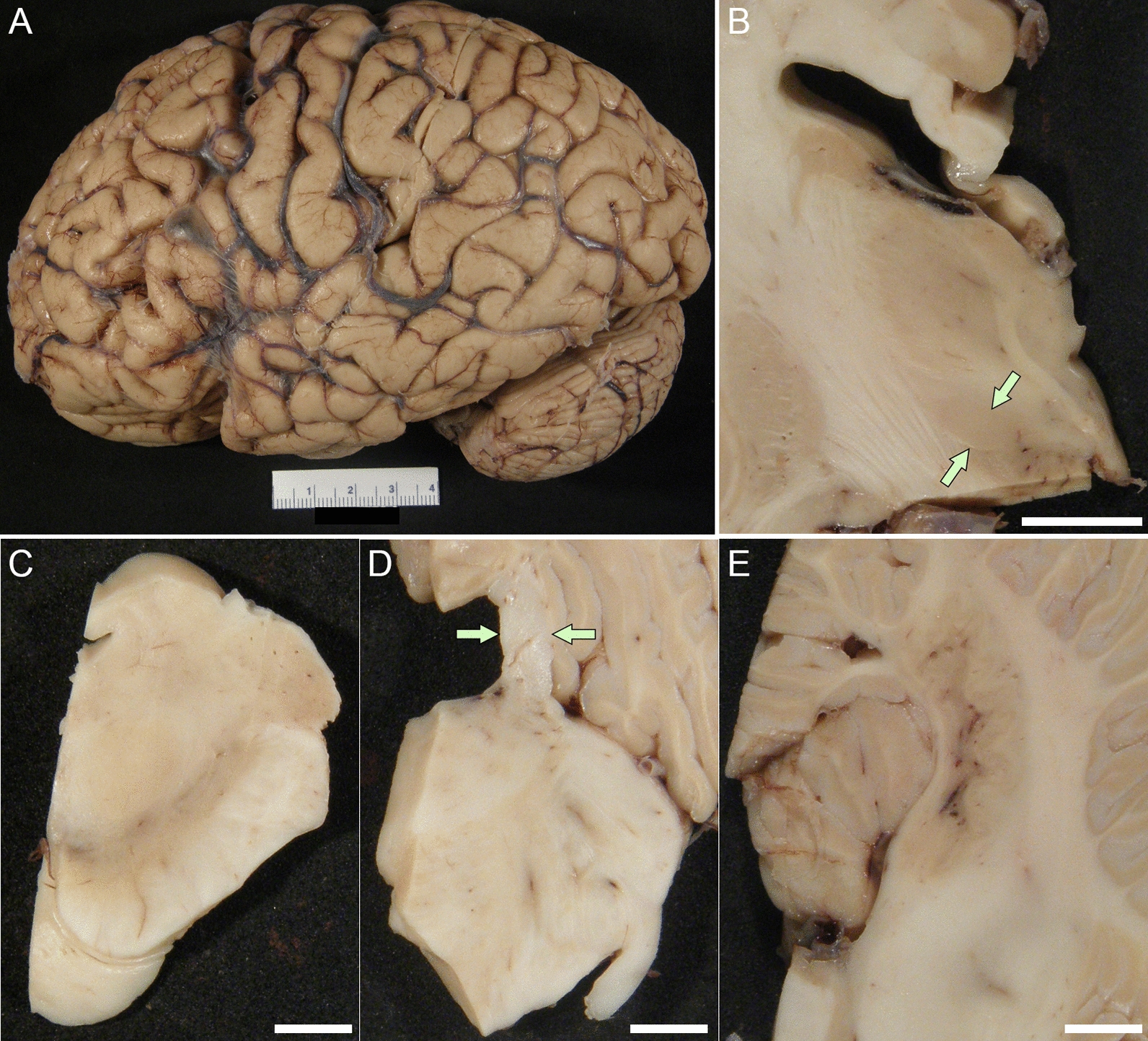 Macroscopic findings of Case 1. A The lateral view of the cerebral cortex is unremarkable. B The volume of subthalamic nucleus is preserved (arrows). C The melanin pigment is depleted in the substantia nigra. D The superior cerebellar peduncle is well preserved (arrows). E The dentate nucleus and cerebellar white matter are unremarkable. Scale bars: 1 cm in B, 5 mm in C-E