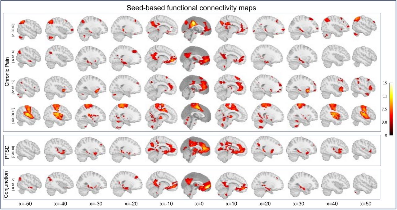 Graphical representations of SBC maps, shown as T-statistic maps, seeded in the peak coordinates obtained from the ChP and PTSD meta-analyses and the conjunction analysis. These maps were generated using resting-state functional magnetic resonance imaging (rs-fMRI) data from a subset of 30 participants (age: M = 29.2 years, SD = 3.32; 20 females) drawn from the publicly available Human Connectome Project dataset (HCP–Young Adult; for details see https://www.humanconnectome.org/hcp-protocols-ya-7t-imaging). Color bar represents T-statistics. Abbreviations: Conj, conjunction analysis; ChP, chronic pain; PTSD, post-traumatic stress disorder; SBC, seed-based connectivity analysis.