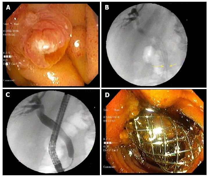 Initial endoscopic retrograde cholangiopancreatography findings. A: Area of the papilla visualized in the 2nd part of the duodenum; B: CBD malignant stricture visualized in the distal CBD with aid of fluoroscopy during ERCP; C: Cannulating the CBD; D: BMS interested into the CBD visualized protruding from the papilla in the 2nd portion of the duodenum. CBD: Common bile duct; ERCP: Endoscopic retrograde cholangiopancreatography; BMS: Bare metal stent.