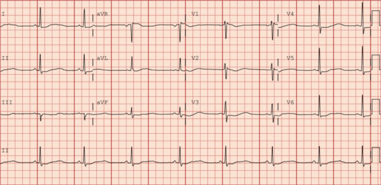 Electrocardiogram on admissionDiffuse QT prolongation most apparent in lead II.