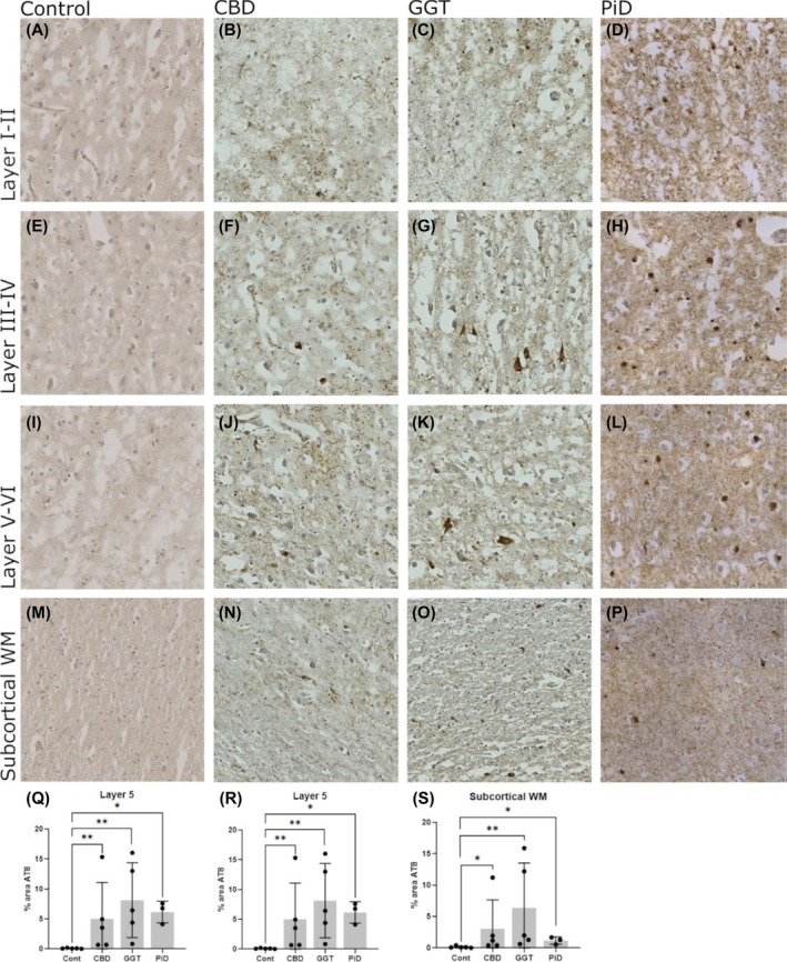 Tau pathology in the cortex of non‐demented control and tauopathy cases. Hyperphosphorylated tau (stained with AT8) was measured in cortical layers III–IV, V–VI, and subcortical white matter (WM) in control, CBD, GGT, and PiD. Controls were negative for AT8 immunoreactivity in all regions (A), (E), (I), (M). Image analysis demonstrated that tau signal (% area AT8 positive) varied between cases and layers, with tau most abundant in the pyramidal Layers (III–V) (B), (C), (F), (G), (J), (K), (N), (O), (Q), (S). Tau levels were consistently higher in GGT compared to other disease types in all layers, although not significant due to large variability between cases (Q), (R), (S). Control, n = 5; CBD, n = 5; GGT, n = 5; and PiD, n = 3. Error bars = mean ± SD. Scale bar = 100 μm.