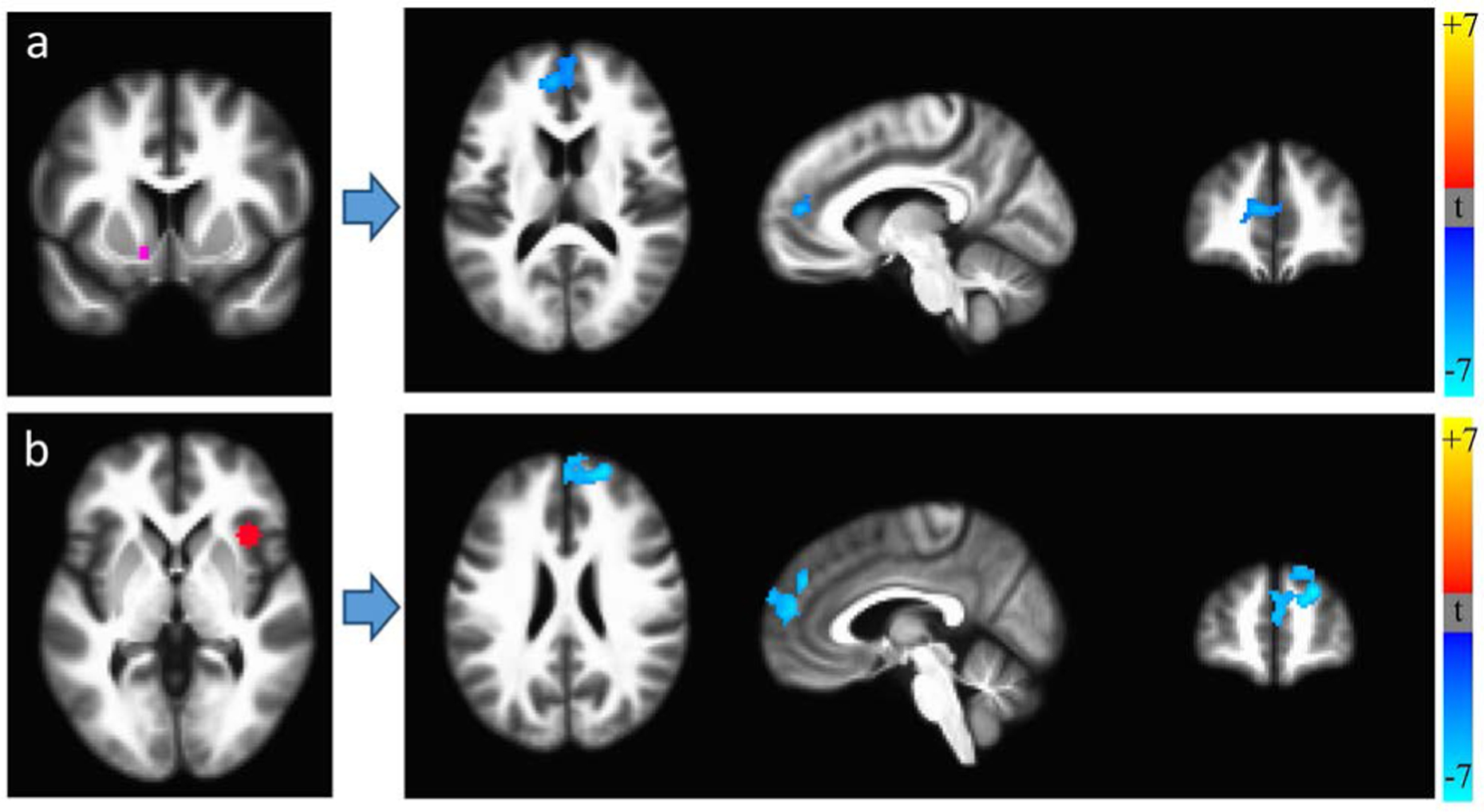 Resting-state functional connectivity differences between HIV+ (N = 21) and HIV− (N = 36) participants, controlling for age. HIV+ individuals exhibited lower RSFC between (a) a seed region in the left nucleus accumbens (left panel) and medial prefrontal cortex (mPFC), and (b) a seed region in the right anterior insula (left panel) and mPFC.