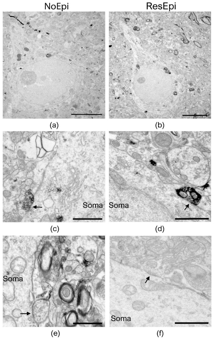 Electron microscopy of temporal neocortical slices stained with CB1R. Layer 2/3 pyramidal cells are shown on low magnification electron micrographs, taken from sections stained with the perisomatic interneuron marker CB1R, derived from non-epileptic (a) and epileptic (b) patients. Both CB1R+ (c,d) and CB1R– (e,f) axon terminals give symmetric (inhibitory) synapses to the cell body (soma) of the pyramidal neurons (black arrows). All pictures were taken in regions where SPA was generated in electrophysiological recordings. Scale bars: (a,b): 5 µm, (c–f): 1 µm.