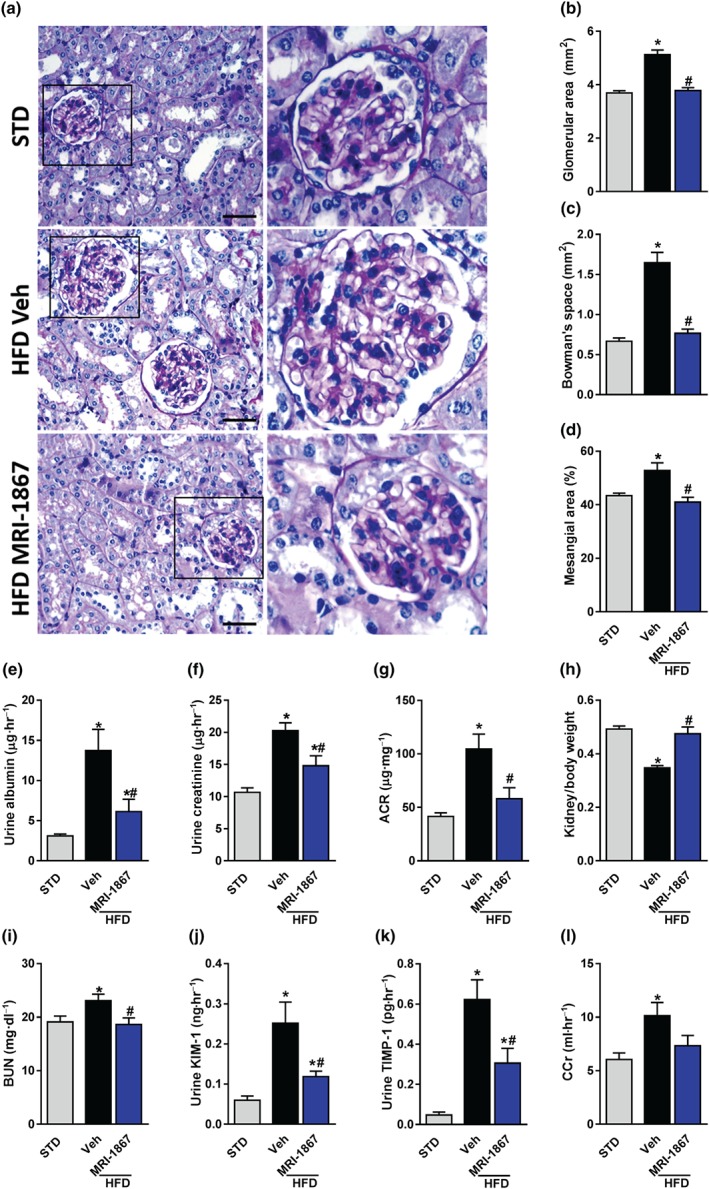 MRI‐1867 improves kidney morphology and function in diet‐induced obese mice. Mice on standard diet (STD) or high‐fat diet (HFD) for 18 weeks were treated with vehicle (Veh) or MRI‐1867 (3 mg·kg−1) orally for 28 days. Chronic MRI‐1867 treatment protected diet‐induced obese (DIO) mice from obesity‐induced morphological changes, such as (a, b) glomerular enlargement, (a, c) increased Bowman's space area, and (a, d) mesangial expansion. Moreover, MRI‐1867 treatment improved kidney function, indicated by reduced urinary (e) albumin and (f) creatinine levels, as well as (g) the albumin‐to‐creatinine ratio (ACR). (h) Reduced kidney‐to‐body weight ratio, (i) elevated blood urea nitrogen (BUN), and (j) urinary secretion levels of kidney injury marker 1 (KIM‐1), and (k) tissue inhibitor of metalloproteinase 1 (TIMP‐1) were normalized in MRI‐1867‐treated DIO mice. (l) A tendency towards reduction in creatinine clearance (CCr) was also observed in DIO mice treated with MRI‐1867. Scale bar, 20 μm. Data represent the mean ± SEM from 8 to 14 mice per group. * P < .05, significantly different from animals on STD; # P < .05, significantly different from animals on the same diet; one‐way ANOVA, followed by a Bonferroni post hoc test