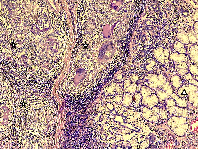 Gx200 coloration HE – inflammation granulomateuse folliculaire faite de cellules épithélioïdes et de cellules géantes de type Langhans limitées en périphérie par une couronne lymphocytaire (étoiles) à proximité de glandes salivaires muqueuses (triangle)Gx200 HE stain – follicular granulomatous inflammation made up of epithelioid cells and Langhans-type giant cells bordered on the periphery by a lymphocytic crown (stars) close to mucous salivary glands (triangle)