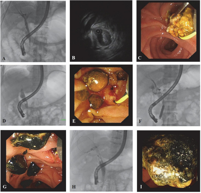 Cholangiographic, IDUS, and endoscopic images from typical cases. Patient 1: A 37-year-old male choledocholithiasis patient was diagnosed with abdominal ultrasonography. (A) The cholangiographic image failed to reveal the stones. (B) IDUS confirmed the presence of stones in the bile duct, but the number of stones was not accurate. (C) During lithotomy, a large amount of sludge was pulled out. Since more than three extractions were done, the score of stones was modified as score 3. Patient 2: A 65-year-old female patient diagnosed with choledocholithiasis by abdominal CT scan. (D) Only one stone was found under the shaft of the endoscope, while stones inside the end of the common bile duct could not be seen. (E) More than five brownstones were extracted, and most of them existed in the lower part of the common bile duct. Patient 3: A 75-year-old male choledocholithiasis patient was diagnosed with abdominal ultrasonography. (F) Cholangiography demonstrated many stones in the middle part of the common bile duct, and stones in the cystic duct can also be seen. (G) Black calculus with different sizes was taken out. Patient 4: A 68-year-old male patient was diagnosed with choledocholithiasis by abdominal CT scan. (H) Stones <1 cm were shown above the shaft by cholangiography. (I) The long diameter of the stone was around 1.2 cm.