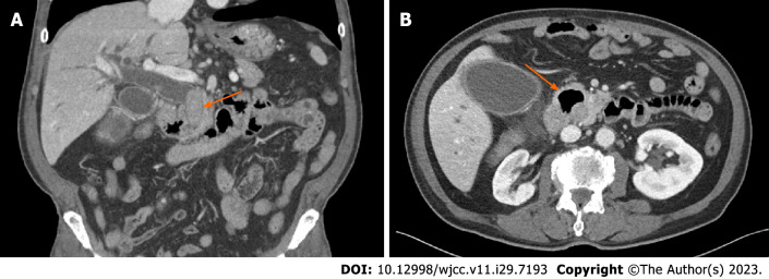 Preoperative computed tomography finding. A: Impacted large common bile duct stone (arrow); B: Large duodenal diverticulum (arrow).
