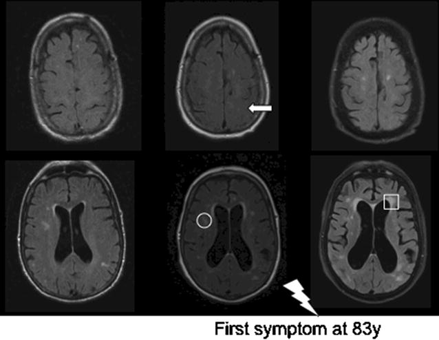 Pre- and post-symptomatic magnetic resonance images of a patient that developed symptoms after 10 years. The MRI images show the changes in ventricle width, deterioration of white matter hyperintensities (circle: deep; square: periventricular) and tight high convexity (arrow) all before onset of symptoms (thunderbolt) of a typical case. Left: 10 years before symptom onset. Middle: 4 years before symptom onset. Right: 6 months after symptom onset