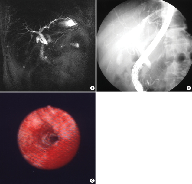 Studies of a 59-yr-old male patient. While radiologic findings suggested a malignant distal common bile duct stricture, PTCS and biopsy findings revealed a benign stricture. (A) MRCP image showing abrupt and asymmetric narrowings. (B) ERCP image showing abrupt and asymmetric narrowings. (C) PTCS image showing no tumor vessel or mucosal abnormality.