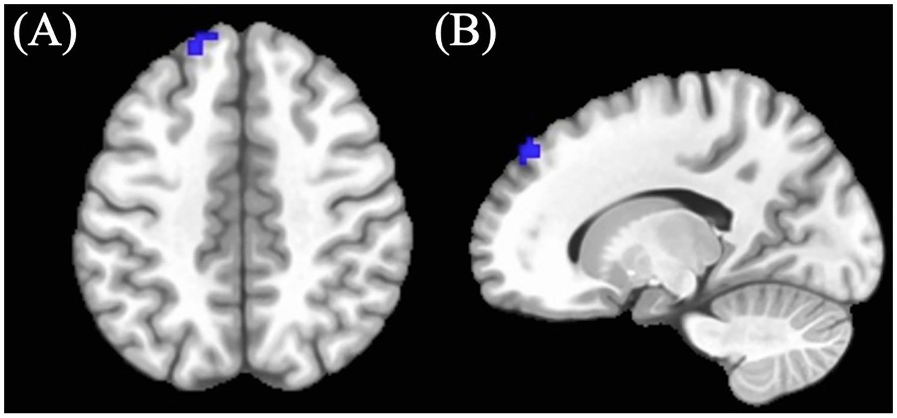 Significant positive > neutral No-go BOLD cluster between cannabis-using and non-using participants. (A) Axial and (B) sagittal view of left superior frontal cluster demonstrating decreased BOLD response in cannabis-using group relative to non-using group.