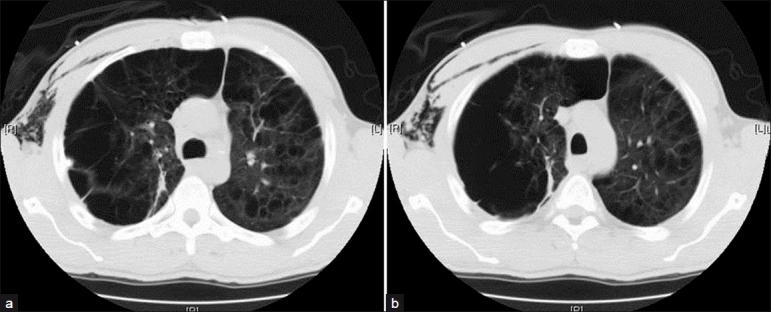 Computerized tomographic scan showing severe bilateral upper lobe bullous lung disease