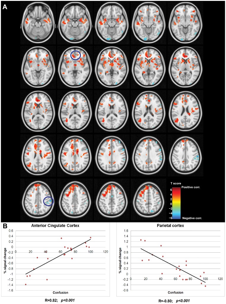 Correlation between BOLD response and the feeling of confusion.(A) Voxel-wise correlation analysis between the BOLD response and the feeling of confusion. Hot colour bar represents regions showing a positive correlation between these two variables, while cold colour bar represents the negative correlation. Maps, thresholded at p<0.005 and k>40 are superposed on a standard brain in the MNI (Montreal Neurological Institute) space and visualized in axial view with slices spaced 3 mm in the z axes. Regions highlighted by the blue circles are the ones plotted in panel B. (B) The left-most plot shows the linear correlation between the mean BOLD response in the cluster located in ACC and the feeling of confusion (p<0.001 corrected). The right-most shows the linear correlation between the BOLD response in the cluster located in the right parietal cortex and the feeling of confusion (p<0.001 corrected). Percent of signal change of BOLD response was averaged across all the voxels belonging to the cluster. Corresponding Pearson’s correlation coefficients (R) are displayed on the bottom of each plot.