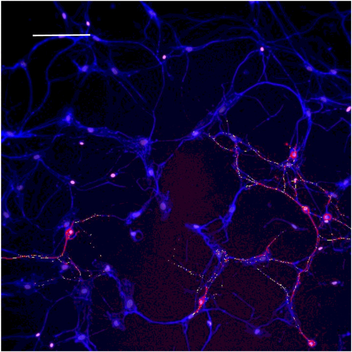 Immunofluorescent image of GPR55 (yellow) and NLRP3 (red) immunoreactivity spots on neurons from Day 9 dorsal root ganglion culture: evidence for co-localization of spots on same neurons DRG neurons (purple) were identified with antibodies to beta-3 tubulin and nuclei are shown as pink spots using Hoechst 33342 dye. The calibration bar = 150 m.