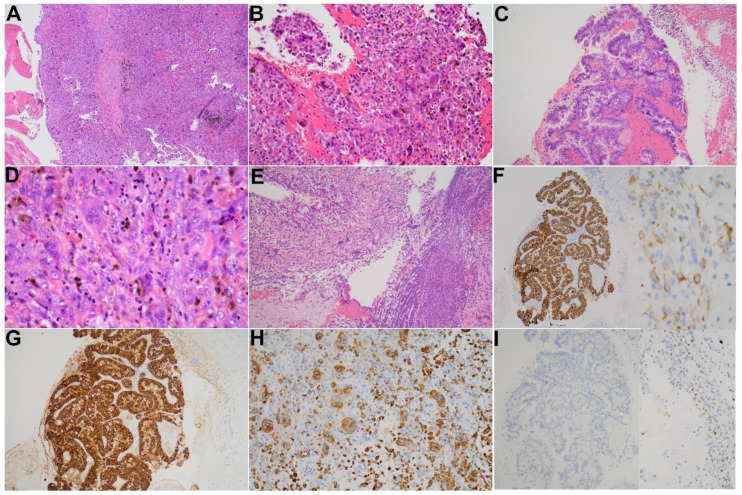 Pathological features of this case. (A) Hypercellular tumor in a background of hemorrhage and numerous hemosiderin pigments (H&E stain, ×40). (B,D) The tumor is composed of three cell types including OGCs, mononuclear histiocytes and neoplastic mononuclear cells (H&E stain, ×100 and ×400, respectively). (C) Malignant epithelia exhibiting papillary and tubular glandular structure (H&E stain, ×100). (E) Foci of tissue necrosis and inflammatory exudates (H&E stain, ×100). (F) Immunohistochemistry of AE1/AE3 highlights the malignant epithelia and mononuclear neoplastic cells (×100). (G) Immunohistochemistry of CK19 highlights the malignant epithelia (×100). (H) Immunohistochemistry of CD68 highlights the osteoclast-like giant cells and mononuclear histiocytes (×100). (I) Immunohistochemistry of p53 is expressed in some neoplastic cells (×100).