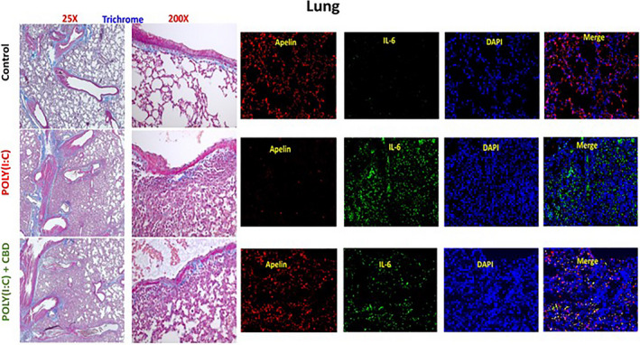 CBD improved the symptoms of Poly(I:C)‐induced ARDS and normalized the apelin expression in the lung tissues. Masson's trichrome analysis of lung tissues showed that intranasal administration of high dose Poly(I:C) caused the destruction of normal morphology and structure of lung, hypertrophy, fibrosis and pulmonary oedema, as compared to the tissues from control group. CBD treatment improved the structure towards the normal architecture (bright filed images on the left panel). Further, immunofluorescence analysis of lung tissue (panels on the right side) showed a decrease in Apelin in Poly(I:C) treated lung compared to normal tissues. CBD treatment normalized the Apelin expression in the lung, indicating the potential protective effect of CBD