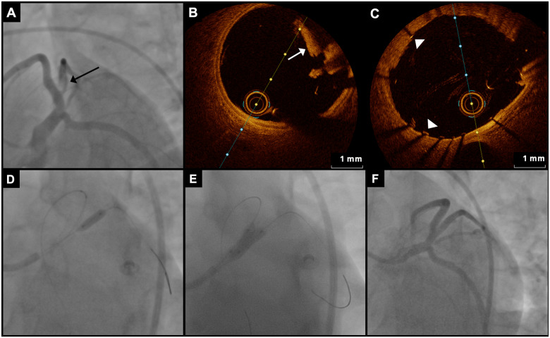 Imaging of the thrombotic occlusion of the first diagonal branch (black arrow in A) 8 months after the first event. (B) Thrombus visualization (white arrow) with optical coherence tomography in the diagonal branch. (C) The previously implanted stent in the left anterior descending artery was well-adapted (white arrowheads). After balloon dilatation (D) implantation of a drug-eluting stent in the diagonal branch was performed using the ‘kissing-balloon’ technique (E). Coronary blood flow could be fully re-established (F).