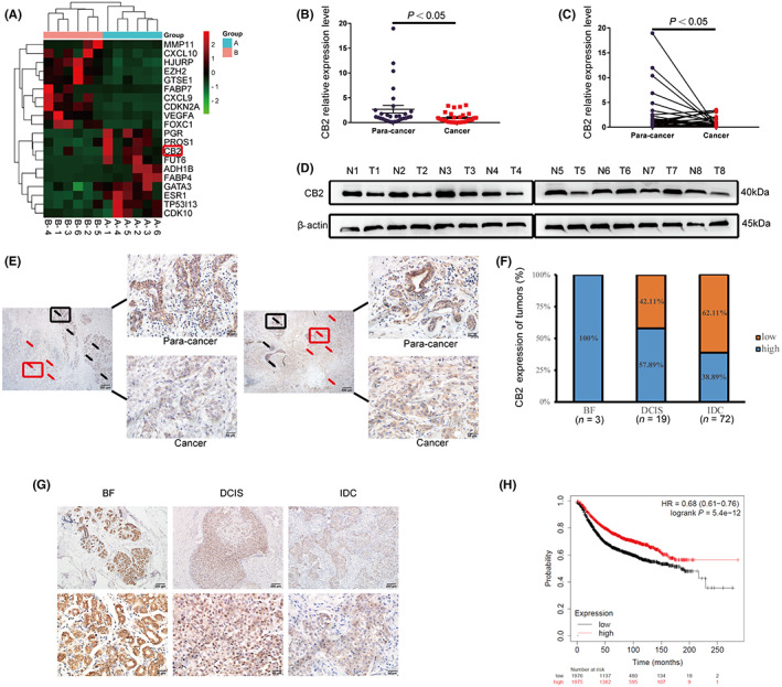 Cannabinoid receptor 2 (CB2) was downregulated in breast cancer (BC) and correlated with the prognosis of BC patients. (A) CB2 expression was measured using RNA sequencing technologies in six paired BC samples. Group B is cancer tissue and A is adjacent tissue. (B and C) CB2 mRNA expression level was determined in 30 paired BC and paracancerous tissues by qRT‐PCR. (D) Representative images of CB2 protein expression in eight paired BC (T) and paracancerous tissues (N). (E) Representative immunohistochemistry (IHC) images showing CB2 expression in BC and paracancerous tissues. Black arrows represent the para‐cancer tissue, red arrows represent cancer tissue. Scale bars: 500 μm, 40×; 50 μm, 400×. (F and G) Quantification and representative IHC images showing CB2 expression in 95 BC tissues. BF, breast fibroadenoma; DCIS, ductal carcinoma in situ, IDC, invasive ductal carcinoma. (H) Kaplan–Meier survival curve analysis showed that BC patients with high expression of CB2 had longer overall survival than patients with low expression. GAPDH and β‐actin were used as normalizing genes for qRT‐PCR. Data presented as mean ± standard deviation (SD), *p < 0.05.