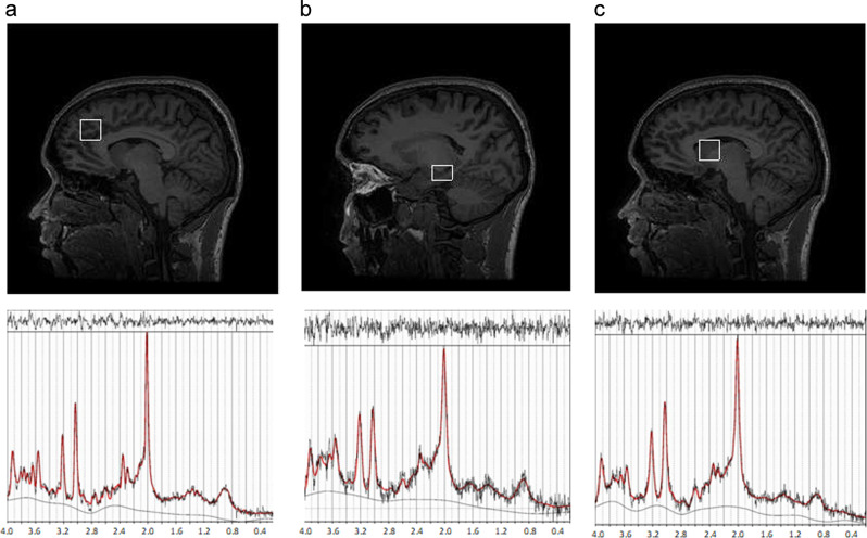 1H-MRS data acquisition. 1H-MRS, proton magnetic resonance spectroscopy. a Left anterior cingulate cortex (ACC), b left hippocampus, and c left head of the caudate