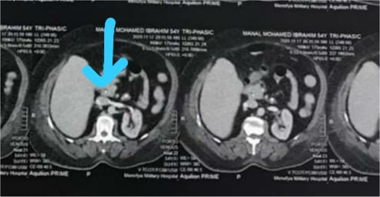 A faint thin stent hardly seen (atypical surgical catheter) on CT images