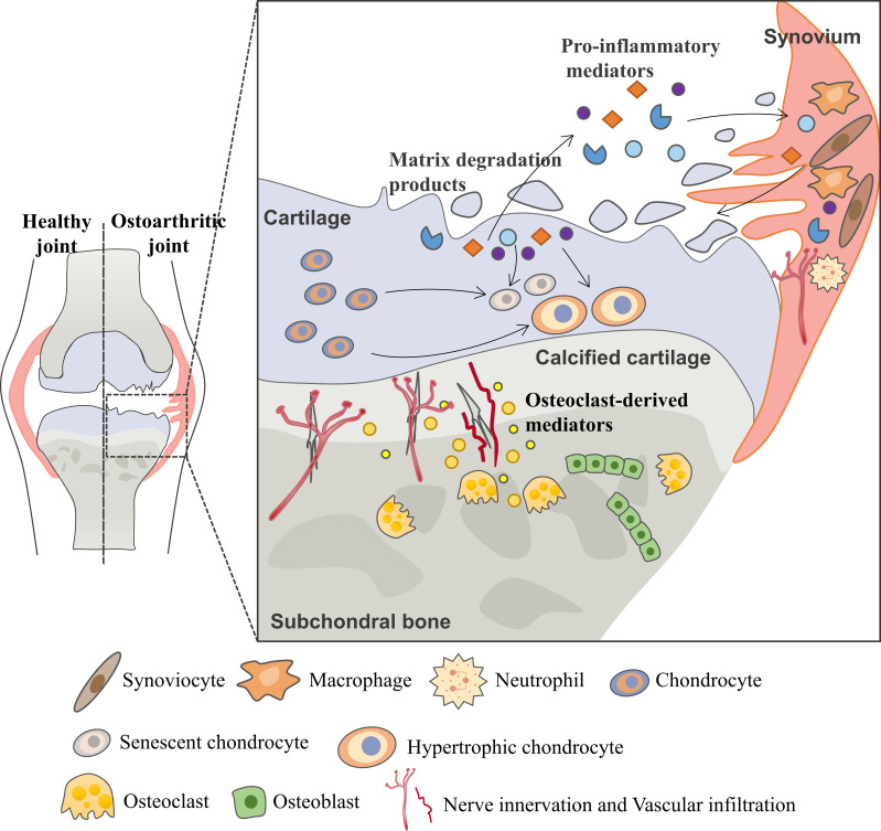Vicious cycle during OA progression. During the osteoarthritis process, the imbalance between the anabolic activities and catabolic activities of cartilage ECM-degrading enzymes (aggrecanases and matrix metalloproteinases) leads to further extracellular matrix degradation. Products from matrix degradation act on the synovium to induce inflammation and the release of pro-inflammatory mediators (cytokines, chemokines, etc.) that feedback on chondrocyte and cause cartilage breakdown. This process also promotes phenotypic alterations of chondrocytes and leads to chondrocytes hypertrophy and senescence. In the subchondral bone, osteoclasts are activated in response to abnormal mechanical loading and pro-inflammatory mediators, resulting in bone resorption and release of osteoclast-derived mediators which regulate sensory innervation and vascular invasion into the osteochondral junction. This process also correlates with OA pain. Abnormal bone remodeling is then followed by increased bone formation, leading to subchondral bone sclerosis. The homeostatic imbalance of the osteochondral unit increases cartilage susceptibility to disruption and contributes to OA pathological processes.