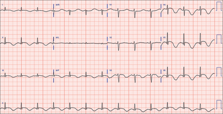 Electrocardiogram at day 2 of admission