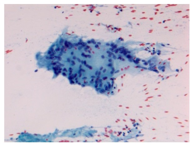 Acute sarcoidosis salivary gland. Cytopathology Pap stain 200×.