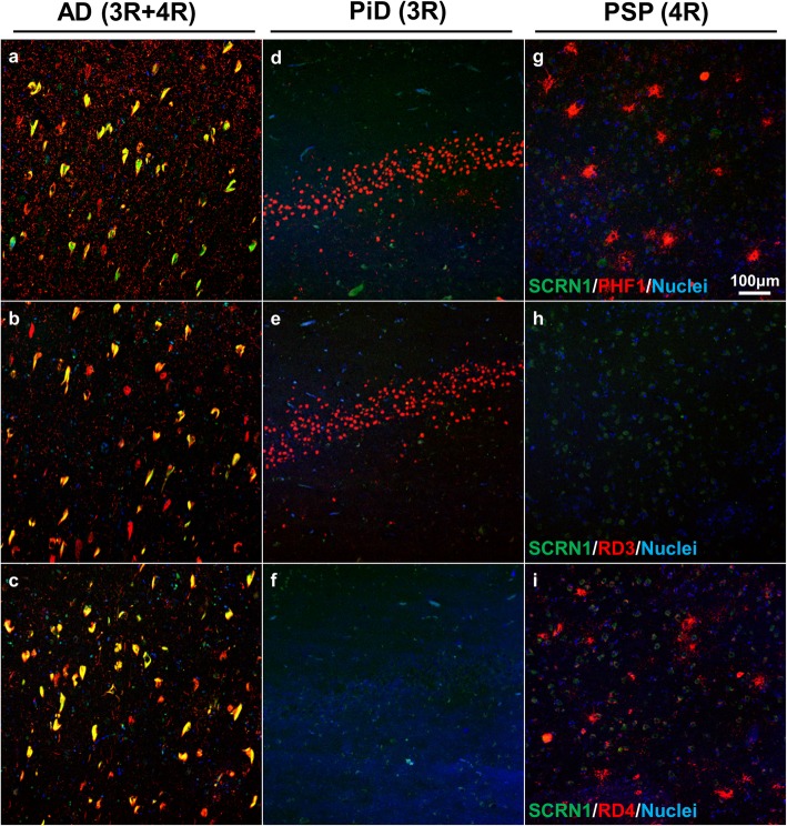 Secernin-1 accumulation is not 3R- or 4R-Tau specific in AD. Sections from hippocampus (a-f) or basal ganglia (g-i) were immunostained with α-SCRN1 (green) and PHF1 (a, d, g; red), RD3 (b, e, h; red) or RD4 (c, f, i; red) in AD (a-c), PiD (d-f) or PSP (g-i) cases