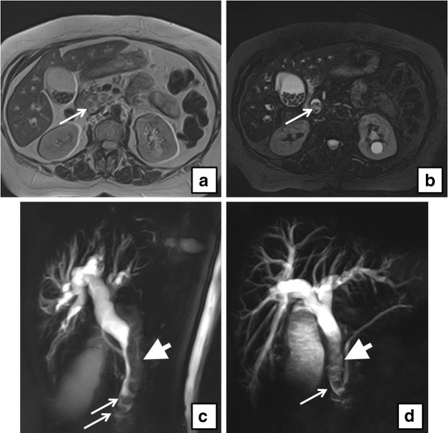 a Axial T2-weighted MRI shows multiple filling defects in the gallbladder and in the dilated CBD (arrow) . b Axial fat-saturated T2-weighted MRI of the same patient at the same level of a. c, d Coronal MIP reformat of the same patient shows multiple filling defects in the gallbladder and in the dilated CBD (arrowhead), and two stones are seen in the distal CBD (arrows)