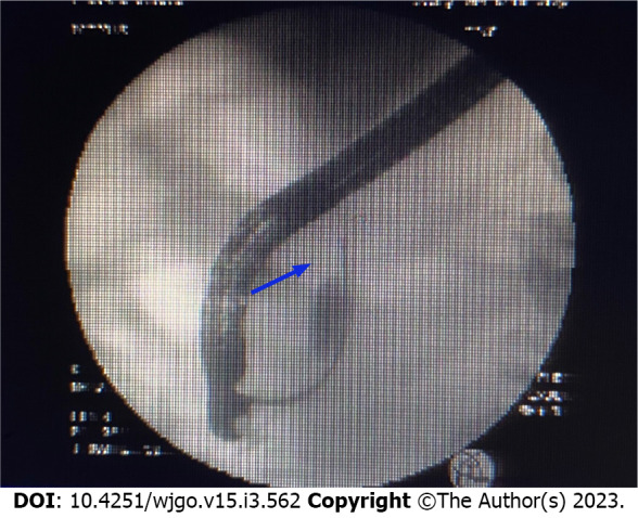 Endoscopic retrograde cholangiopancreatography was recommended for bile duct biopsy and a 7.5 Fr × 7 cm bile duct plastic stent was implanted.