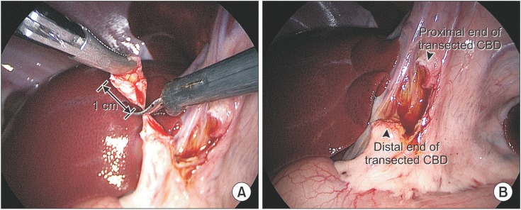 Intracorporeal view of laparoscopic common bile duct (CBD) transection. (A) CBD was transected by laparoscopic scissors at the middle part about 1 cm in length. (B) The view of transectd CBD which is similar to the common cases of iatrogenic CBD transection.