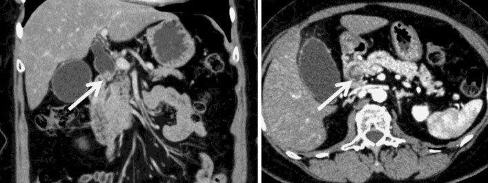 A 25-mm enhanced nodule (arrow) in the middle to inferior portion of the CBD accompanied by proximal dilatation of the bile duct.