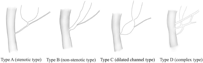 Classification of pancreaticobiliary maljunction. From Urushihara et al. 19 Reprinted with permission from John Wiley & Sons.