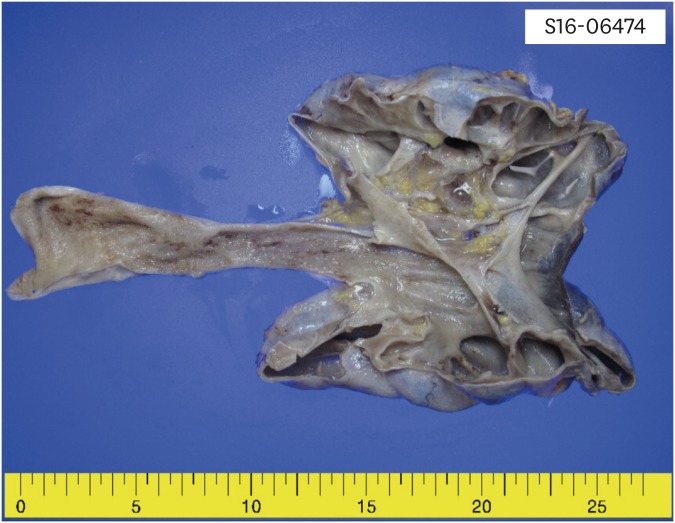 Surgical specimen included dilated renal pelvis ‘P,’ atrophied renal parenchyma ‘K,’ and dilated ureter ‘U.’