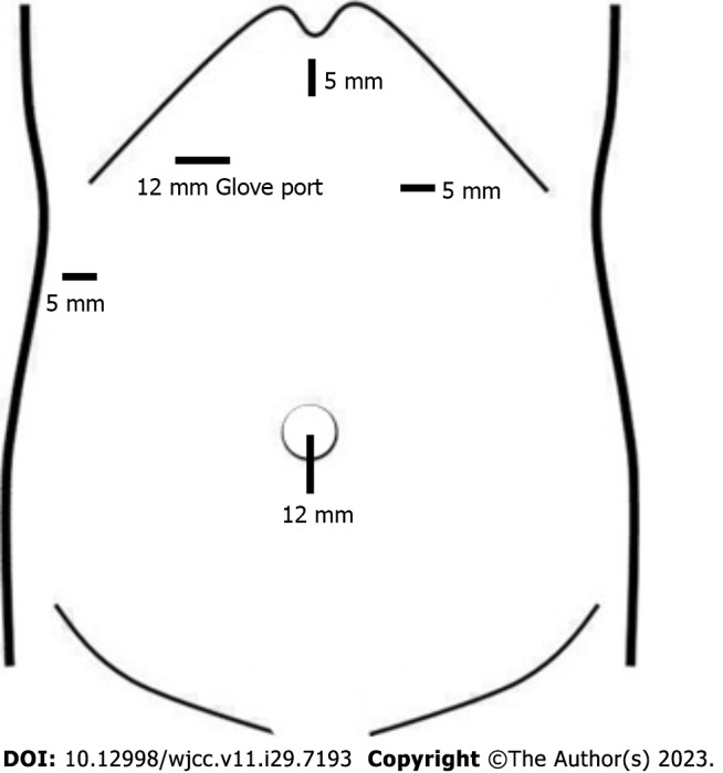 >Location of trocars.